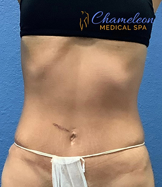 BioSlimming After, DeSoto, TX