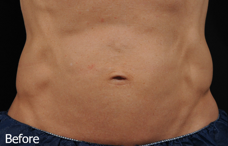 AccuFit Before, DeSoto, TX