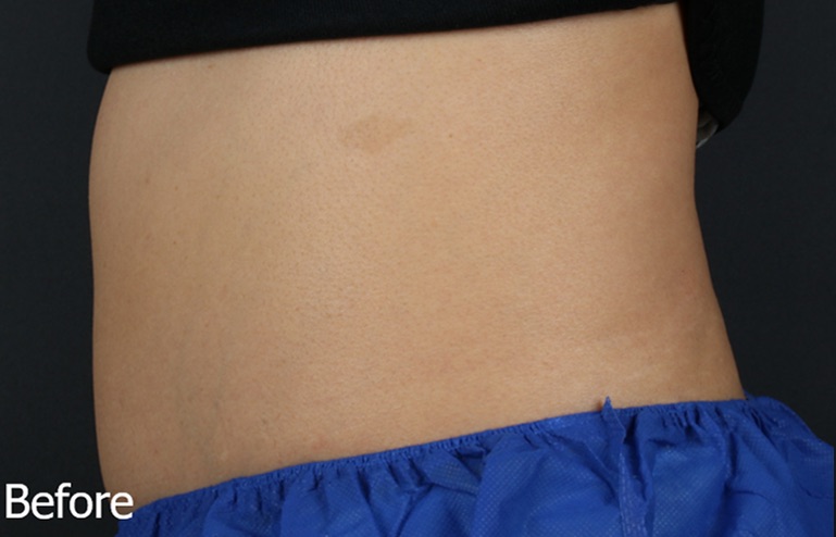 AccuFit Before, DeSoto, TX