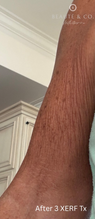 XERF™ structural skin tightening After, DeSoto, TX