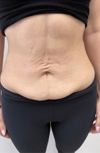 XERF™ structural skin tightening Before, DeSoto, TX