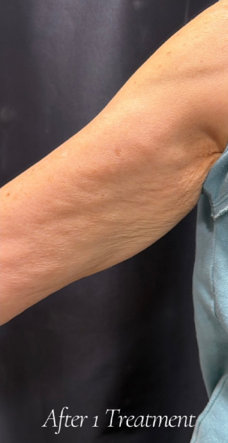 XERF™ structural skin tightening After, DeSoto, TX