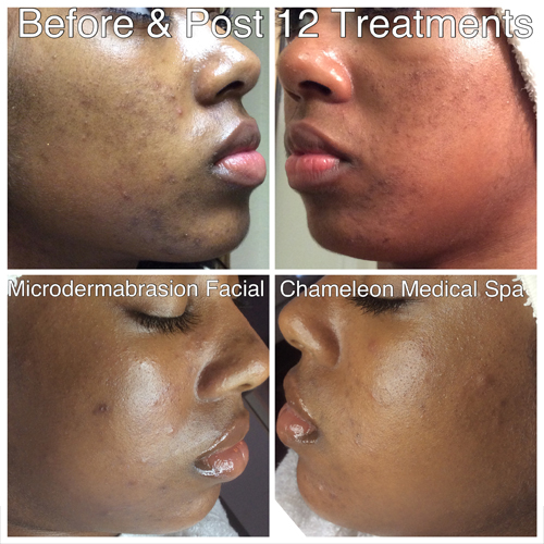 Before & After Microdermabrasion