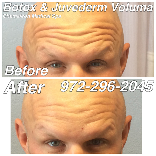BOTOX® Cosmetic and Juvéderm® Voluma Before and After, DeSoto, TX