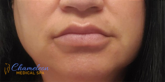 Lip augmentation After, DeSoto, TX