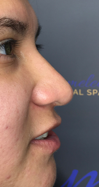 Liquid Nose Job with BOTOX® Cosmetic Before, DeSoto, TX