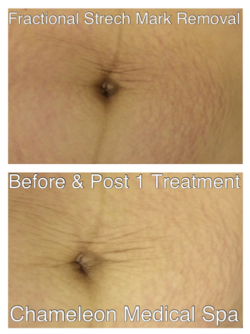 Fractional Stretch Mark Removal Before and After, DeSoto, TX