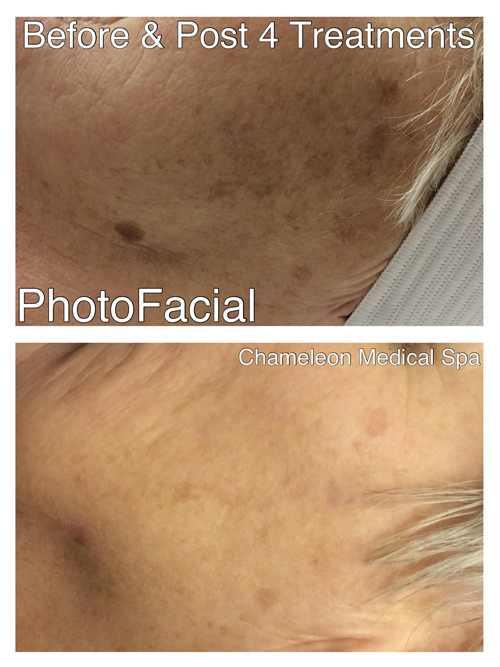 Before & After Skin Rejuvenation