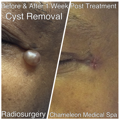 Cyst Removal Before and After, DeSoto, TX