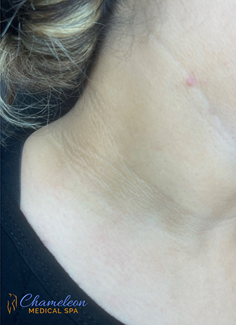 Skin Tag Removal After, DeSoto, TX