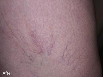After Clarity™ Laser Treatments