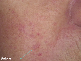 Telangiectasia Removal Before, DeSoto, TX