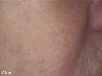 Telangiectasia Removal After, DeSoto, TX