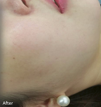 After Clarity™ Laser Treatments