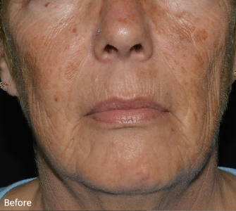 LaseMD Ultra™ Before, DeSoto, TX