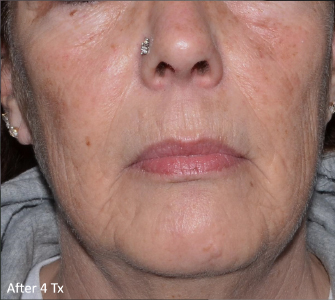 LaseMD Ultra™ After, DeSoto, TX
