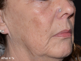 LaseMD Ultra™ After, DeSoto, TX