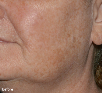 LaseMD Ultra™ Before, DeSoto, TX