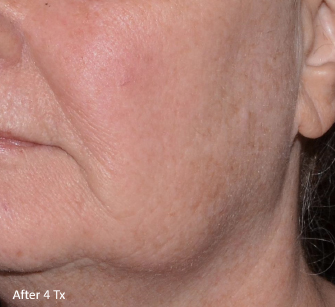 LaseMD Ultra™ After, DeSoto, TX
