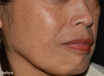 LaseMD Ultra™ Before, DeSoto, TX