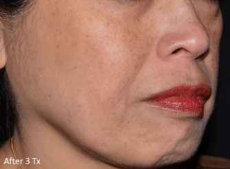 LaseMD Ultra™ After, DeSoto, TX