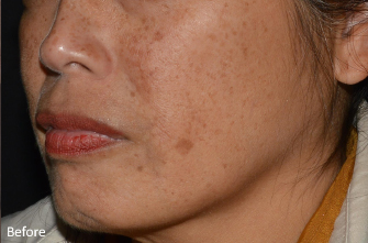 LaseMD Ultra™ Before, DeSoto, TX