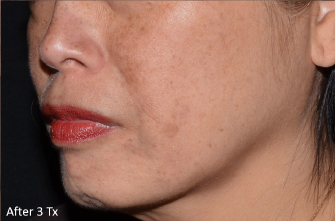 LaseMD Ultra™ After, DeSoto, TX