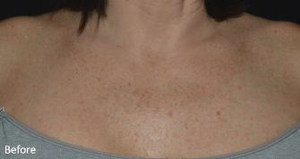LaseMD Ultra™ Before, DeSoto, TX
