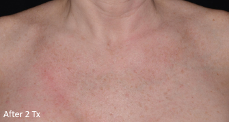 LaseMD Ultra™ After, DeSoto, TX