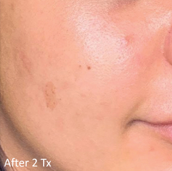 LaseMD Ultra™ After, DeSoto, TX