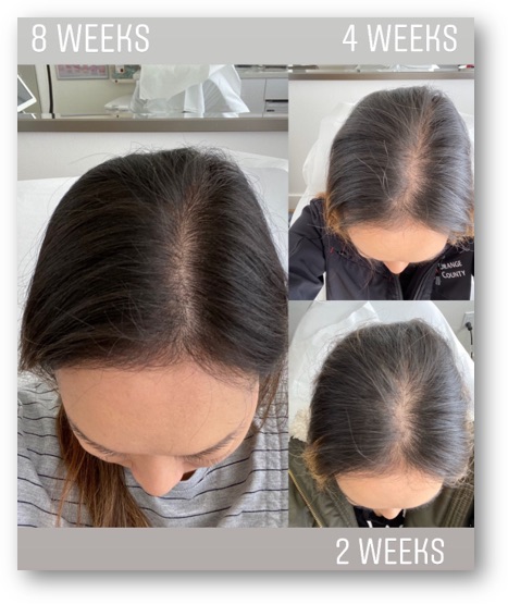 KeraLase™ Before and After, DeSoto, TX