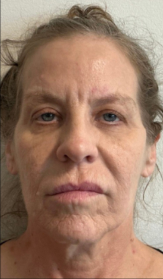 XERF™ structural skin tightening Before, DeSoto, TX