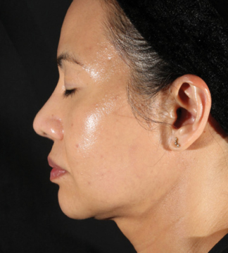 XERF™ structural skin tightening Before, DeSoto, TX