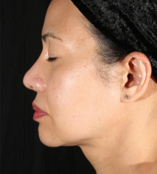 XERF™ structural skin tightening After, DeSoto, TX