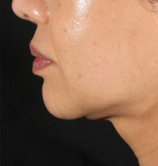 XERF™ structural skin tightening Before, DeSoto, TX