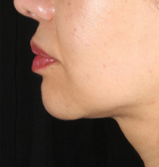XERF™ structural skin tightening After, DeSoto, TX