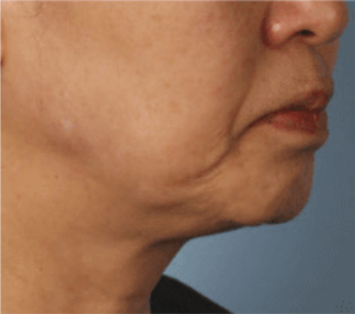 XERF™ structural skin tightening Before, DeSoto, TX