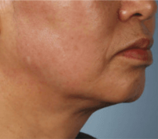 XERF™ structural skin tightening After, DeSoto, TX