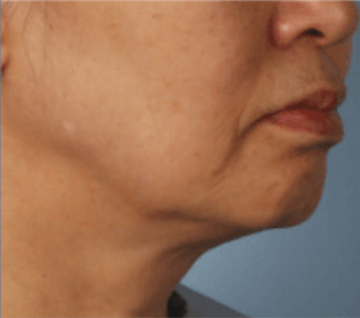 XERF™ structural skin tightening Before, DeSoto, TX