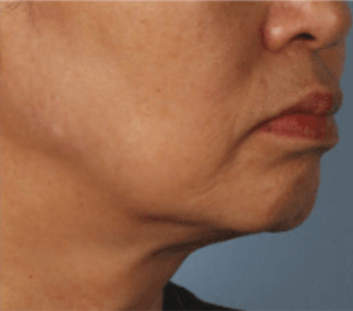 XERF™ structural skin tightening After, DeSoto, TX