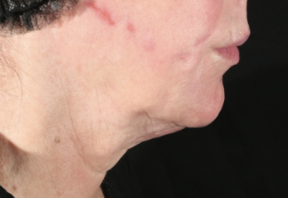 XERF™ structural skin tightening Before, DeSoto, TX