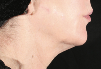 XERF™ structural skin tightening After, DeSoto, TX