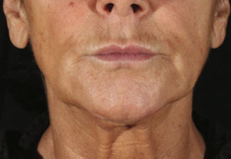 XERF™ structural skin tightening Before, DeSoto, TX