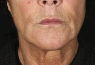 XERF™ structural skin tightening After, DeSoto, TX