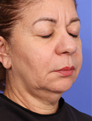 XERF™ structural skin tightening Before, DeSoto, TX