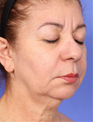XERF™ structural skin tightening After, DeSoto, TX