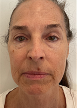 XERF™ structural skin tightening Before, DeSoto, TX