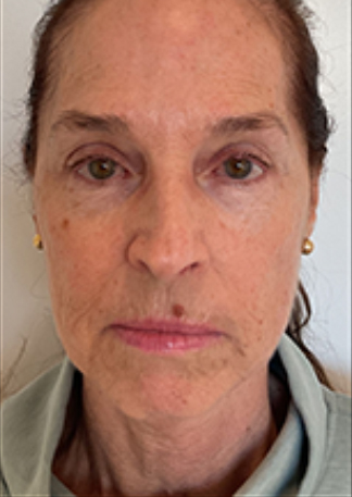XERF™ structural skin tightening After, DeSoto, TX