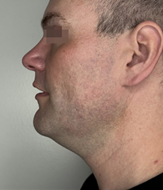 XERF™ structural skin tightening Before, DeSoto, TX