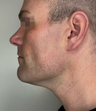 XERF™ structural skin tightening After, DeSoto, TX